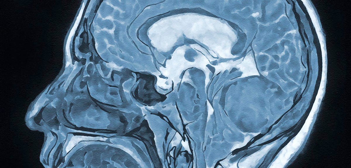 Hypnose bei Hirnoperationen: Einblicke und Verfahren