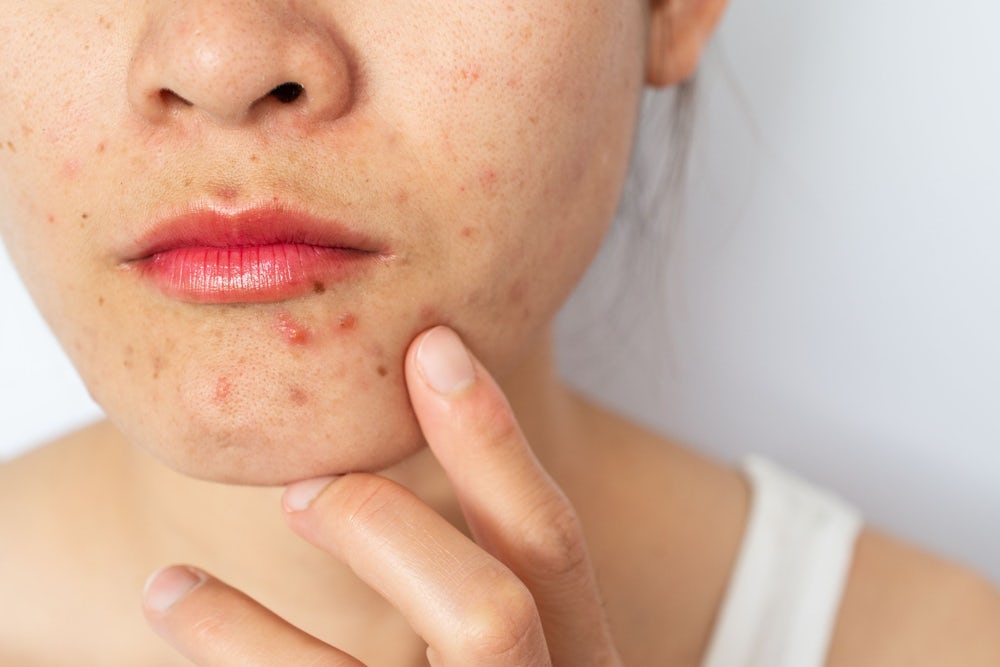 Akne: Einblicke von Dermatologe Alexander Kreuter