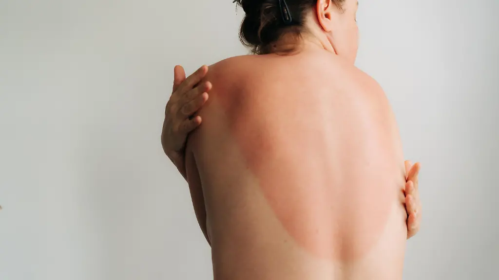 Krebsrisiko durch UV-Strahlung: Ein schwerer Sonnenbrand kann erhebliche Folgen haben