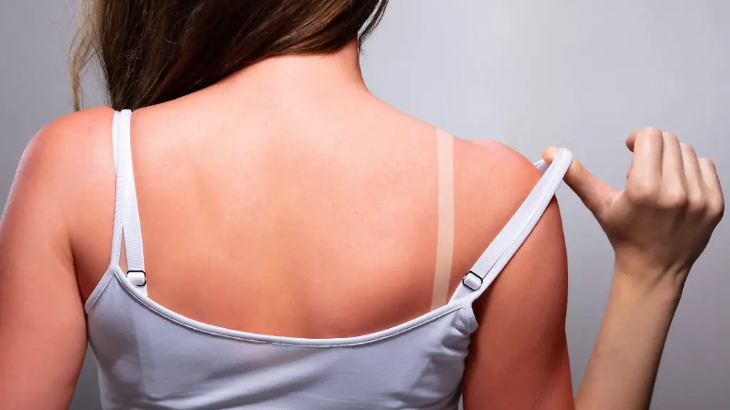Tanmaxxing: Gefährliche Sonnenbrände als Trend