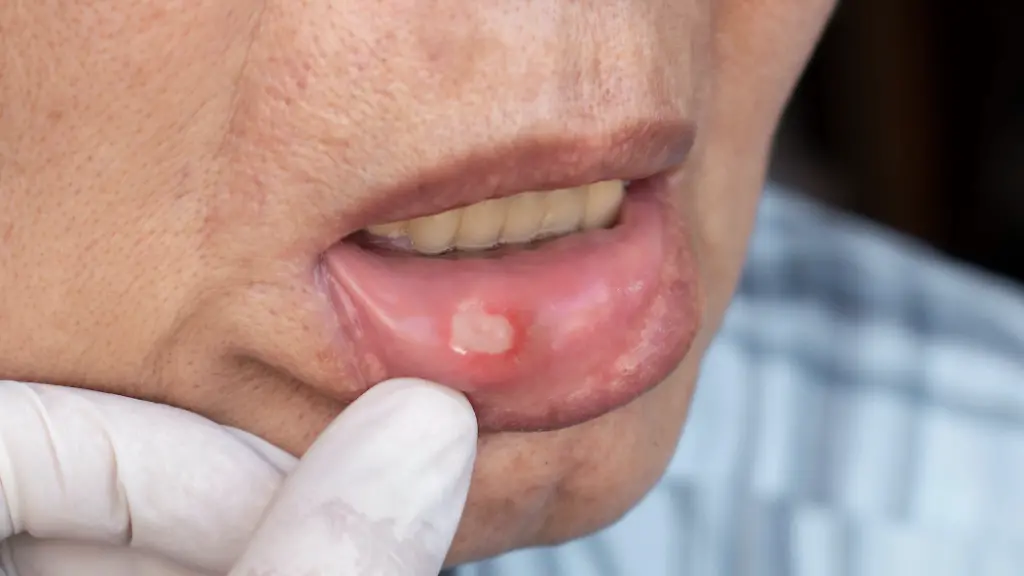 Effektive Hilfe bei Aphthen im Mund